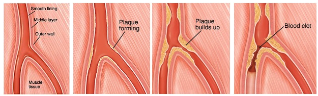 how to treat peripheral vascular disease