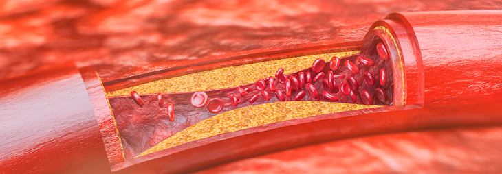 Coronary Artery Disease | Arkansas Heart Hospital