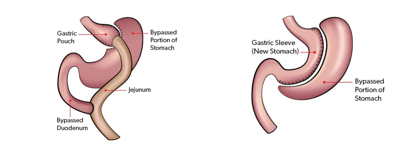 Gastric bypass surgery and gastric sleeve surgery graphics.